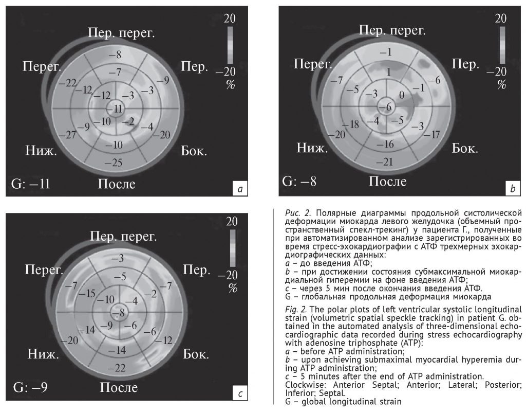 Полярные диаграммы продольной систолической деформации миокарда левого желудочка (объемный пространственный спектл-трекинг)