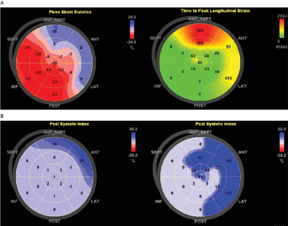 Рис. 3. Топографическое представление (мишень ― bull’s-eye) различных измерений деформации. А ― представлена продольная деформация (слева) и время до пика продольной деформации (справа) у пациента с тяжелым стенозом левой передней нисходящей артерии. Обратите внимание на хроматическую индивидуализацию зоны ишемии (слева), также показана задержка сокращения (красная зона с сокращением задержки 286 мс; справа). B ― измерение постсистолического индекса при speckle-tracking эхокардиографии в начале исследования (слева) и при физической нагрузке (50 Вт; справа) у пациента, подвергающегося эхокардиографии с физической нагрузкой. Обратите внимание на ухудшение задержки сокращения ЛЖ в переднебоковой части. После коронарной ангиографии выявлена патология левой коронарной и левой нисходящей артерий сердца. ANT указывает на передний; ANT_SEPT ― переднеперегородочный; INF ― нижний; LAT ― боковой и POST ― задний.