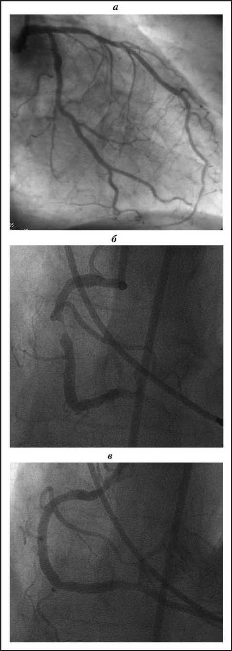 Рис 1. а — ангиограмма левой коронарной артерии: ствол ЛКА не изменен. ПНА (ПМЖВ), ОВ и ВТК проходимы на всем протяжении. б — ангиограмма правой коронарной артерии: ПКА проходима, стеноз 85% в проксимальном сегменте. в — корона-рограмма ПКА после проведение БАП. Отмечается восстановление внутреннего диаметра проксимального отдела ПКА.