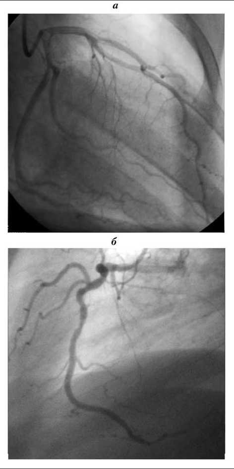 Рис. 2. а — ангиограмма левой коронарной артерии: ствол ЛКА не изменен. ПНА (ПМЖВ), ОВ и ВТК проходимы на всем протяжении. б — ангиограмма правой коронарной артерии: ПКА проходима на всем протяжении без признаков стенозов и тромботических масс.