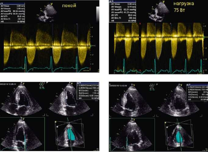 Рисунок 1. Данные стресс-эхокардиографии пациента М., 53 лет, с бессимптомным умеренным аортальным стенозом и умеренной аортальной недостаточностью. Кровоток на аортальном клапане в покое (слева, вверху), на фоне нагрузки (справа, вверху); фракция выброса в 30-режиме в покое (слева, внизу), на фоне физической нагрузки (справа, внизу). Объяснения в тексте.
