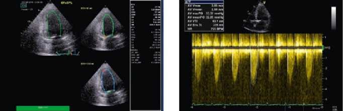 Рисунок 2. Данные эхокардиографии пациента Б., 56 лет, с умеренным аортальным стенозом, максимальным градиентом на аорте 53 мм рт. ст., средним градиентом 33 мм рт. ст. и низкой сократимостью левого желудочка с ФВ 27 %.