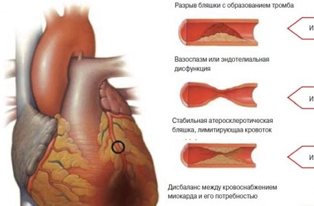 Различия в состоянии коронарных артерий при ИМ типа 1 и типа 2.