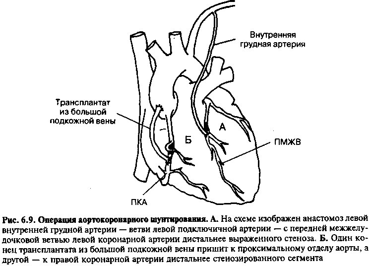 Стеноз артерий сердца